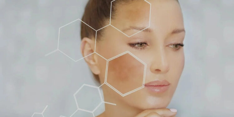 Determine the Causes of Melasma and Get to the Bottom of the Skin Condition